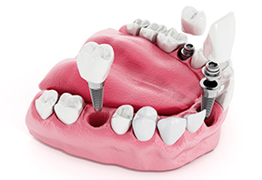 Dental implant in treatment in Wimbledon